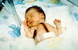 Memphis -- A baby born with a fatal heart defect should live a normal life after undergoing an extremely rare surgery, doctors in Memphis said.