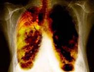 <p>Good news! Good news for those who want go in for TB tests but are apprehensive and suspicious about the currently used lengthy method of testing.</p>
